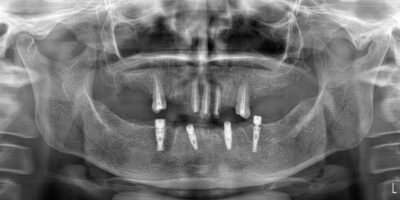MULTIPLE IMPLANTS- IMPLANT DENTISTRY