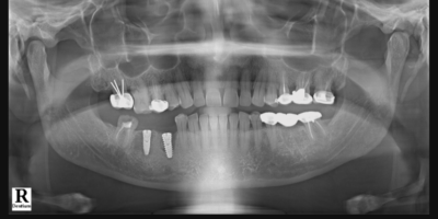 MULTIPLE MISSING TEETH - IMPLANTS